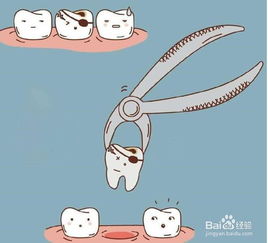 拔大牙前注意事項(xiàng)
