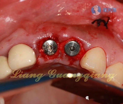 要注意,事項,牙植骨