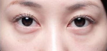 內(nèi)切眼袋術(shù)后注意事項(xiàng),割眼袋術(shù)后注意事項(xiàng),去眼袋術(shù)后注意事項(xiàng)