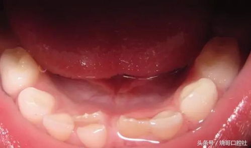 兒童補(bǔ)牙后注意事項(xiàng)有哪些,小孩補(bǔ)牙后注意事項(xiàng),補(bǔ)牙后的注意事項(xiàng)