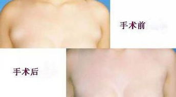 切副乳后注意事項