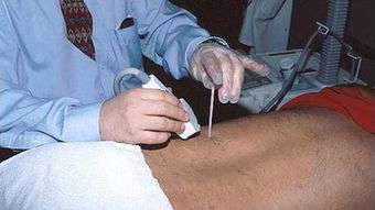 腎穿刺后的注意事項(xiàng),做完腎穿刺的注意事項(xiàng),做過腎穿刺后注意事項(xiàng)