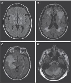 腦炎飲食注意事項,自身免疫性腦炎注意事項,兒童腦炎注意事項
