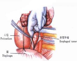 賁門癌手術(shù)后注意事項