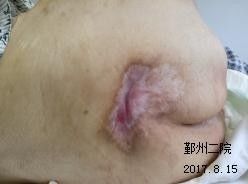 預(yù)防壓瘡的注意事項(xiàng),壓瘡換藥的注意事項(xiàng),壓瘡的護(hù)理要點(diǎn)及注意事項(xiàng)