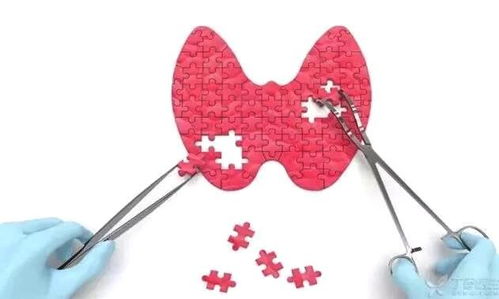 甲狀腺切除術(shù)后注意事項,切掉甲狀腺后注意什么,甲狀腺切除需要注意什么