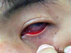 結(jié)膜炎注意事項和如何恢復,結(jié)膜炎一般多久能好結(jié)膜炎注意事項,結(jié)膜炎日常注意事項