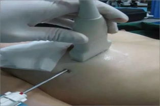 乳房腫瘤微創(chuàng)手術(shù)后注意事項(xiàng)