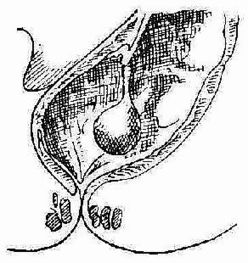 直腸息肉術(shù)后注意事項,直腸腫瘤灌腸的注意事項,直腸藥物灌腸注意事項