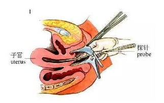 取環(huán)后的注意事項有哪些?,取環(huán)后的注意事項有哪些飲食,取環(huán)后注意事項和調(diào)理