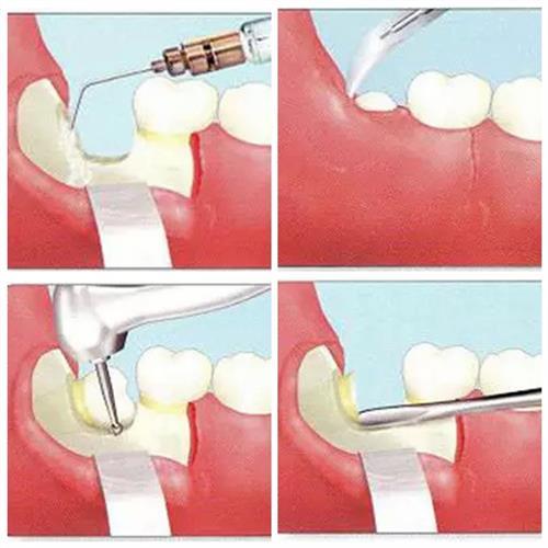 智齒,開(kāi)刀,注意事項(xiàng)