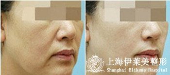 注射,注意事項(xiàng),botox,去川字紋