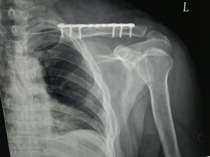 骨折裝了鋼板注意事項