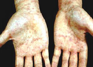 口服紅霉素治療梅毒,紅霉素片治療梅毒,紅霉素治療梅毒效果怎么樣?