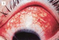 結(jié)膜炎注意事項好大夫在線