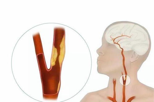 頸動脈b超檢查注意事項,頸動脈彩超檢查注意事項,頸動脈cta檢查注意事項