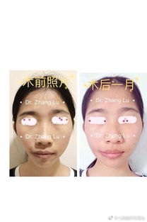 整形,面部,不對稱,注意事項