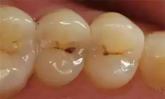 拔牙補牙注意事項