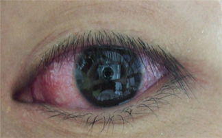 結(jié)膜,要注意,事項(xiàng)