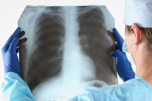 氣胸康復(fù)后注意事項(xiàng)