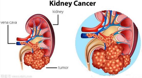 腎癌術(shù)前飲食注意事項(xiàng),腎癌術(shù)后一年注意事項(xiàng),腎癌根治術(shù)后注意事項(xiàng)