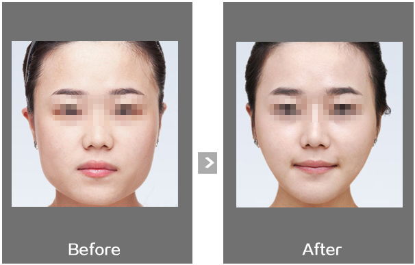 瘦臉針打后的注意事項(xiàng)