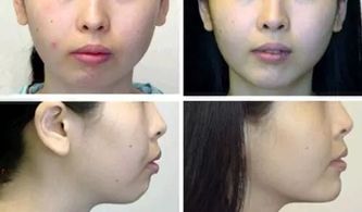 術(shù)后,下巴,注意事項(xiàng)