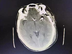 腦動脈瘤夾閉術(shù)后注意事項