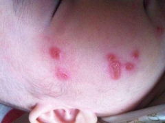 蛇顆瘡注意事項(xiàng)