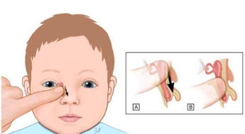寶寶做淚道手術(shù)的注意事項