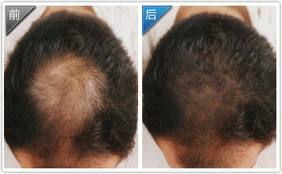 種植頭發(fā)術(shù)后注意事項(xiàng)