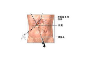 肺葉,切除,手術后,注意事項