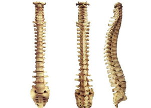 脊柱關節(jié)病的注意事項