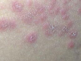 體癬,應注意,事項