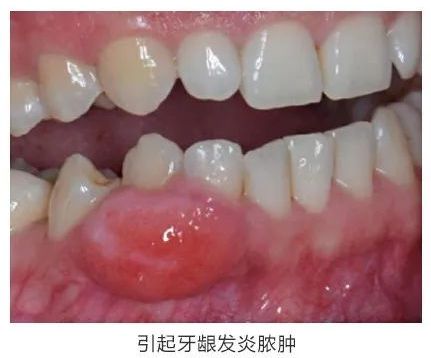 蛀牙后補(bǔ)牙注意事項(xiàng)