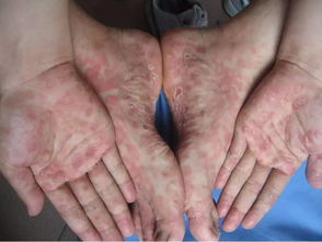 注意事項(xiàng),上藥,hiv