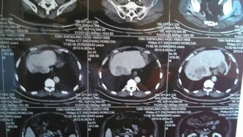 做加強(qiáng)ct注意事項(xiàng)