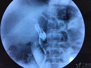 肝臟,術(shù)前,注意事項(xiàng)