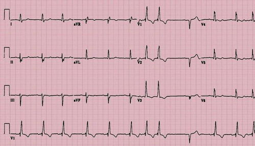 心電圖,跑步,注意事項