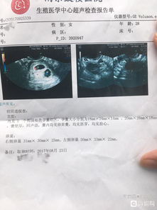 移植雙胎得注意事項