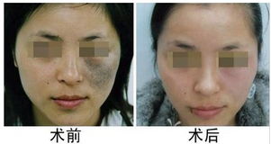 上海第九人太田痣激光后注意事項(xiàng)