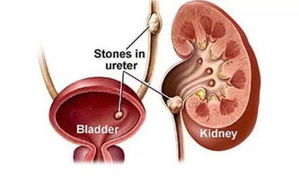 術(shù)后,結(jié)石,注意事項,尿路