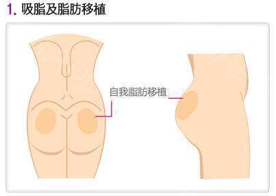 屁股粉瘤手術(shù)后注意事項(xiàng),屁股腫物手術(shù)后注意事項(xiàng),屁股激光手術(shù)后注意事項(xiàng)