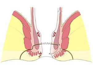 肛瘺手術(shù)前注意事項,肛瘺手術(shù)前一天注意事項,肛瘺手術(shù)后的注意事項