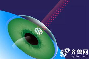 術(shù)前,注意事項(xiàng),屈光