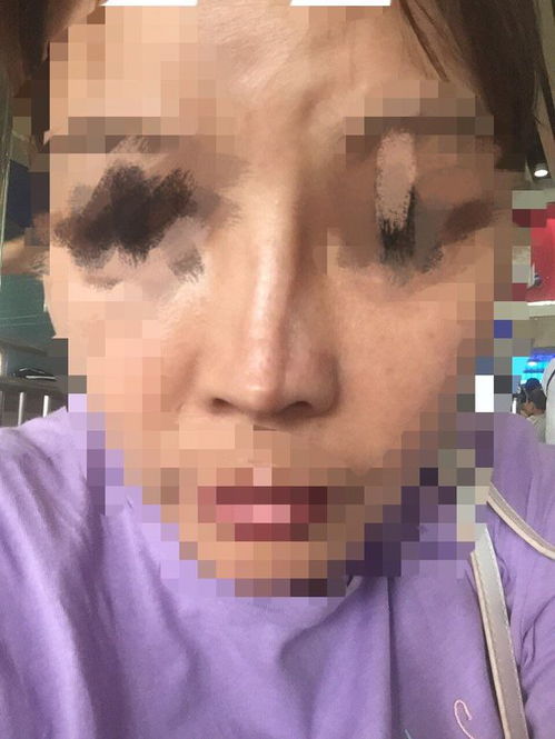 隆鼻術后的10大注意事項,隆鼻術后飲食注意事項,肋骨隆鼻術后注意事項