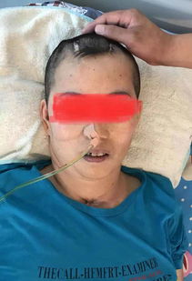 昏迷患者鼻飼注意事項(xiàng)