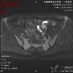 注意事項,增強,檢查,mri