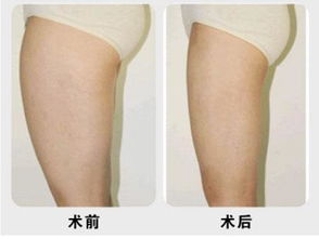 腿部吸脂手術(shù)注意事項(xiàng)