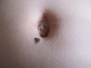 黑色素痣切除后注意事項(xiàng)